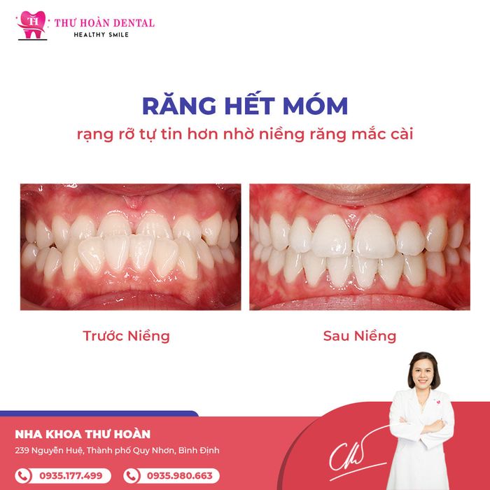 Quy trình niềng răng chuyên nghiệp tại Nha Khoa Thư Hoàn - Healthy Smile