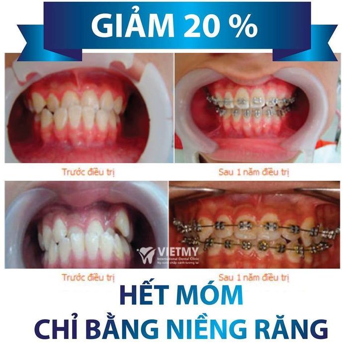 Hình ảnh quy trình niềng răng chuyên nghiệp tại Nha Khoa Paris