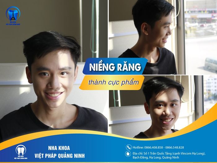 Hình ảnh quy trình niềng răng chuyên nghiệp tại Nha Khoa Việt Pháp