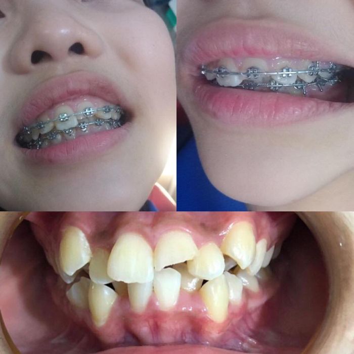 Quy trình niềng răng chuyên nghiệp tại Nụ Cười Duyên