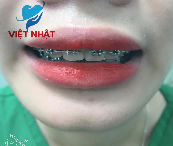 Bộ sưu tập hình ảnh chân thực về quy trình niềng răng chuẩn Nhật tại Nha khoa Việt Nhật