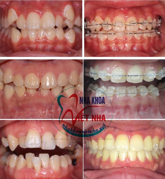 Quy trình niềng răng chuẩn y khoa tại Việt Nha