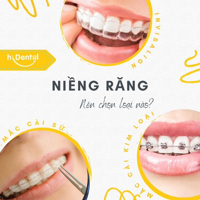 Bộ sưu tập hình ảnh thành công từ các ca chỉnh nha tại Nha khoa hiDental
