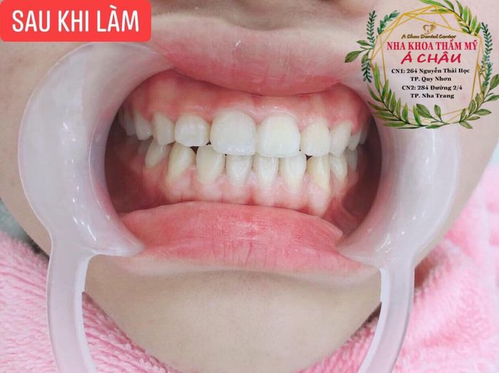 Hình ảnh thực tế về quy trình niềng răng chuyên nghiệp tại Nha Khoa Thẩm Mỹ Á Châu