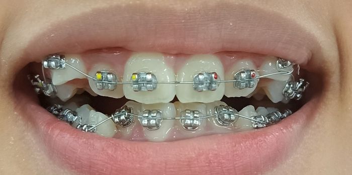 Hình ảnh quy trình niềng răng chuyên nghiệp tại Nha Khoa Việt Đức