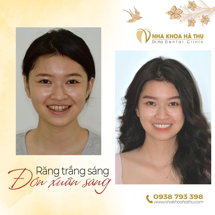 Hình ảnh thực tế tại Nha Khoa Hà Thu - Dr.Ha Dental Clinic