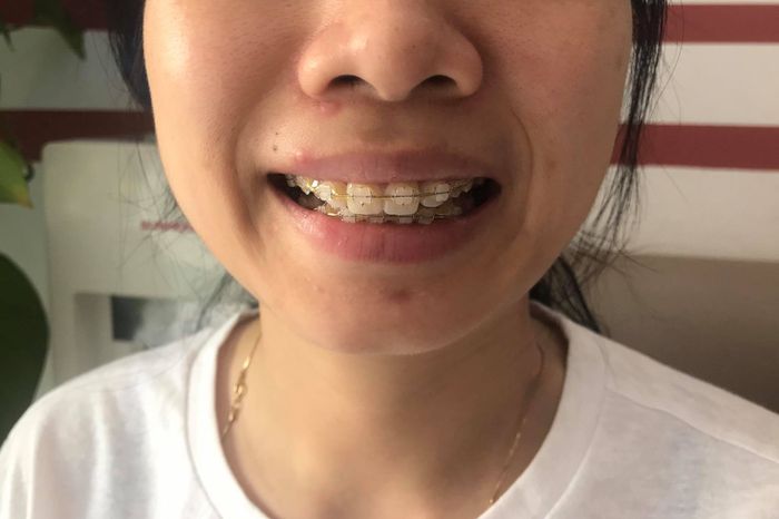 Hình ảnh thực tế về quy trình niềng răng chuyên nghiệp tại Nha Khoa PS Hưng Yên