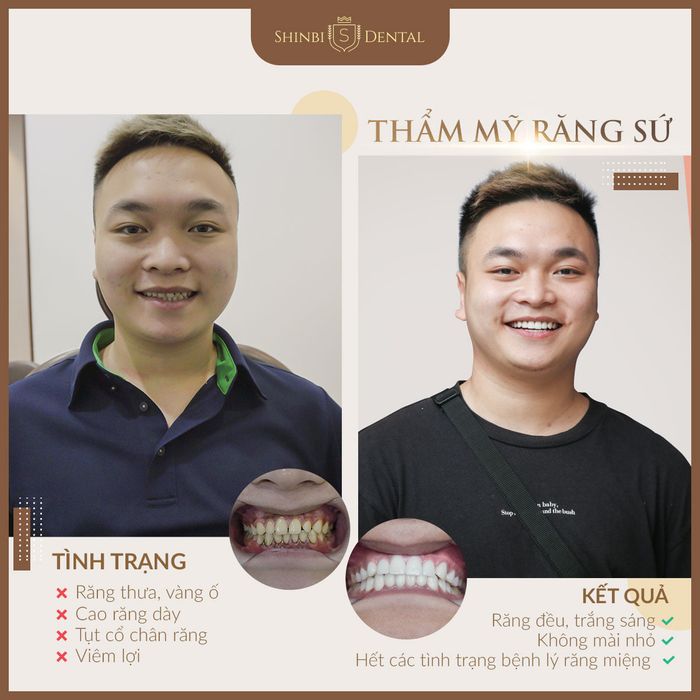 Hình ảnh quy trình bọc răng sứ chuẩn Hàn tại Shinbi