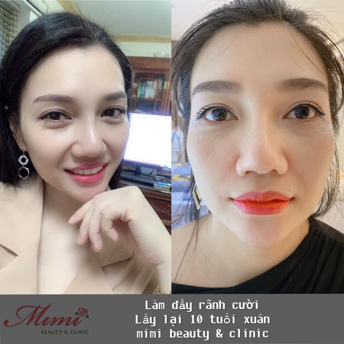 Hình ảnh kết quả làm đẹp ấn tượng tại MiMi Beauty & Clinic