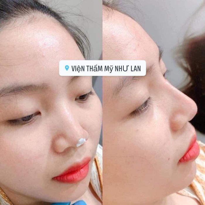 Hình ảnh phòng tiêm chuẩn y khoa tại Viện Thẩm Mỹ Như Lan