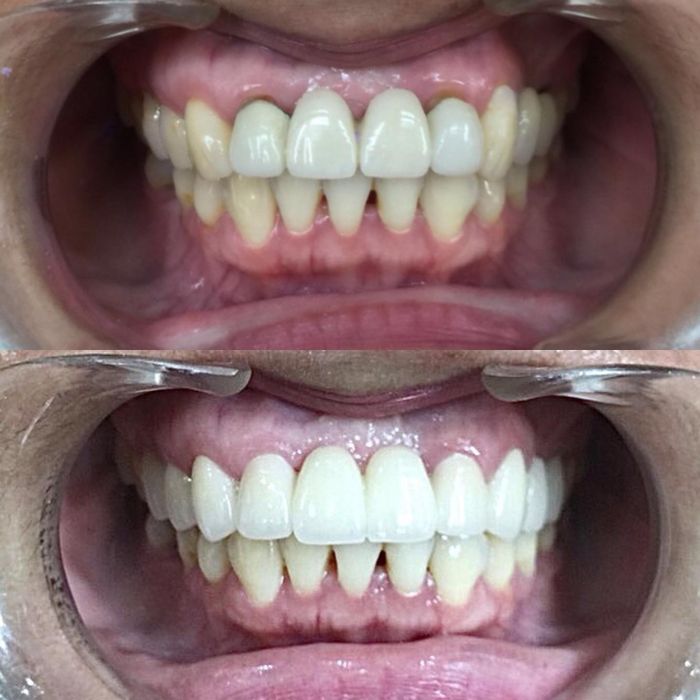 Hình ảnh thực tế quy trình bọc răng sứ tại VinSmile