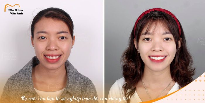 Hình ảnh thực tế quy trình bọc răng sứ tại Nha khoa Vân Anh