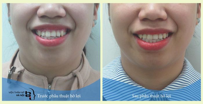 Hình ảnh quy trình phẫu thuật chuẩn y khoa tại Viện Thẩm Mỹ Hà Nội
