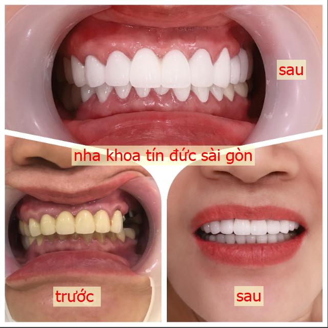 Hình ảnh quy trình điều trị chuẩn y khoa tại Nha Khoa Tín Đức
