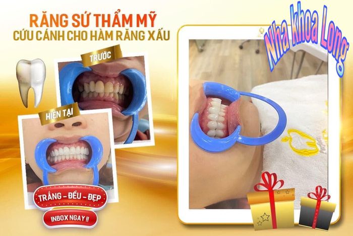 Hình ảnh minh họa quy trình bọc răng sứ chuyên nghiệp
