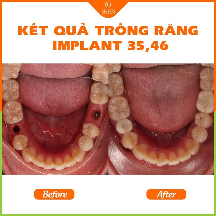 Hình ảnh minh họa dịch vụ trồng răng Implant tại Nha khoa Việt Smile