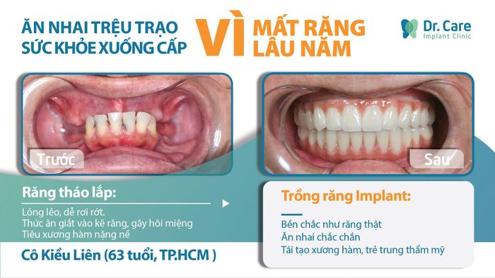 Hình ảnh quy trình trồng răng không đau chuẩn quốc tế tại Dr. Care