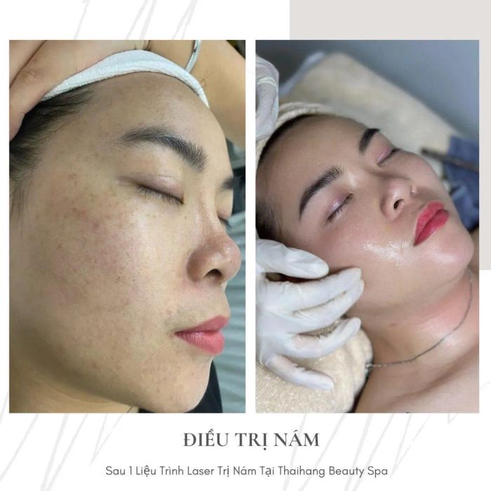 Hình ảnh quy trình điều trị chuyên nghiệp tại Thái Hằng Beauty Spa