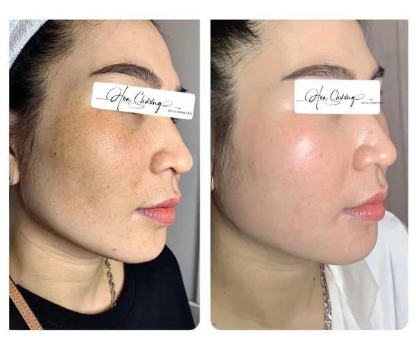 Quy trình trị liệu chuyên nghiệp tại Hoa Chương Spa