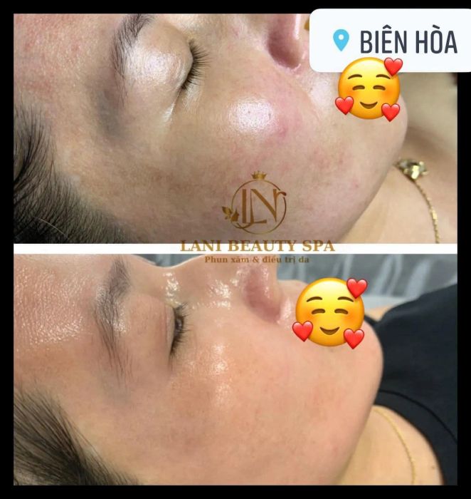 Quy trình điều trị chuyên nghiệp tại Lani Beauty Spa