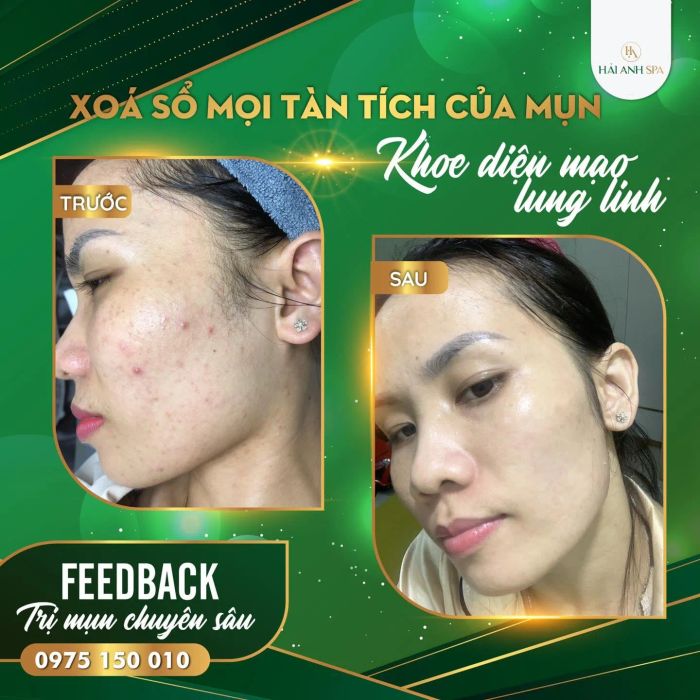 Hình ảnh điều trị tại Spa Hải Anh
