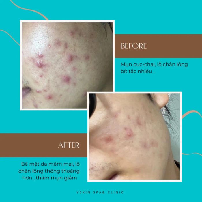 Hình ảnh quy trình điều trị chuẩn y khoa