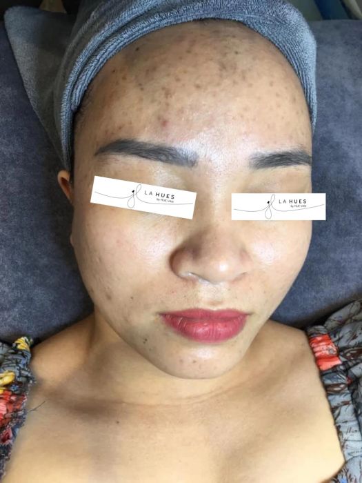 Hình ảnh quy trình điều trị tại La Hues Spa & Clinic