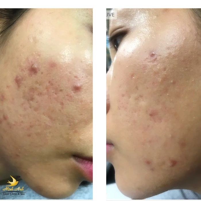 Hình ảnh điều trị tại Minh Anh Laser Clinic & Spa