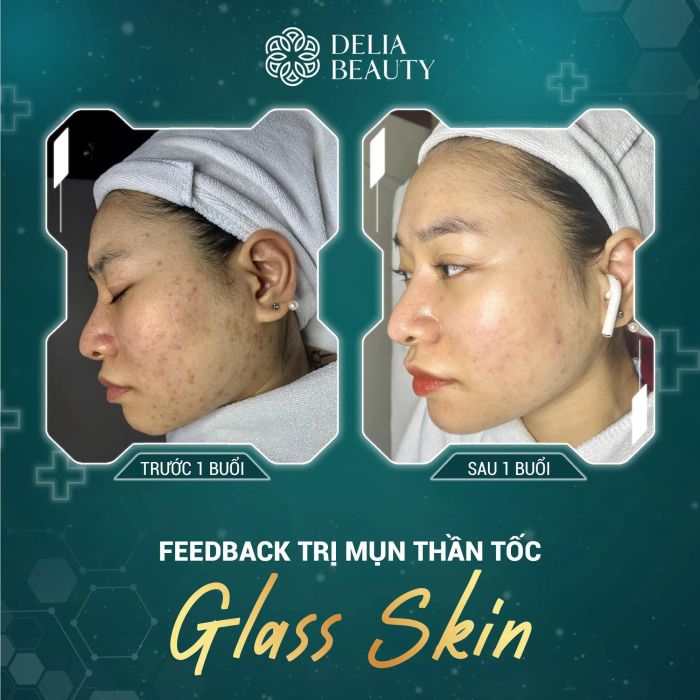 Hình ảnh quy trình điều trị tại Delia Beauty