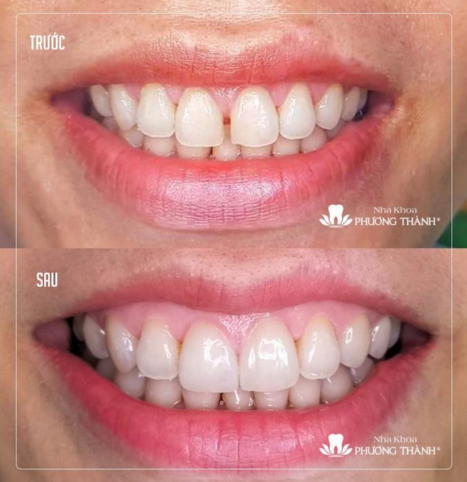 Hình ảnh quy trình điều trị chuẩn y khoa tại Nha Khoa Phương Thành
