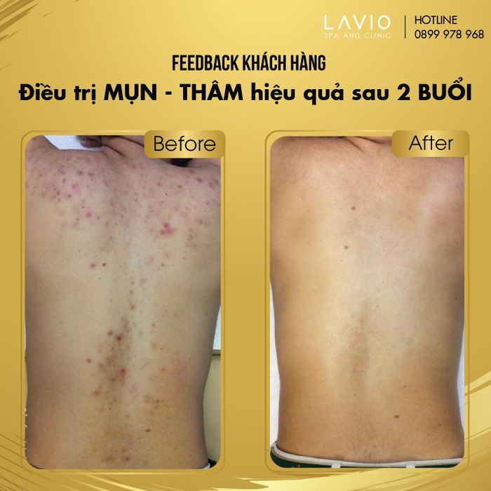 Quy trình IPL trị mụn chuyên nghiệp tại LAVIO