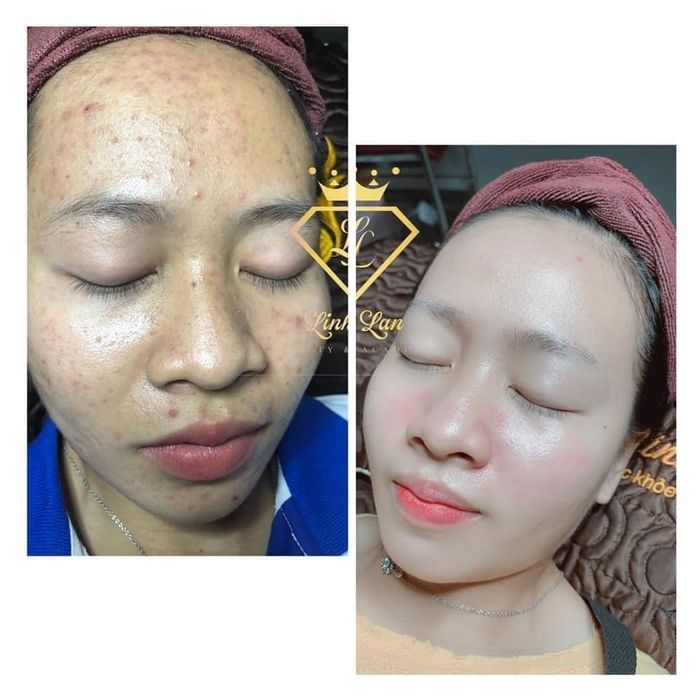 Quy trình nặn mụn bằng ống tre chuyên nghiệp tại Spa LinhLan
