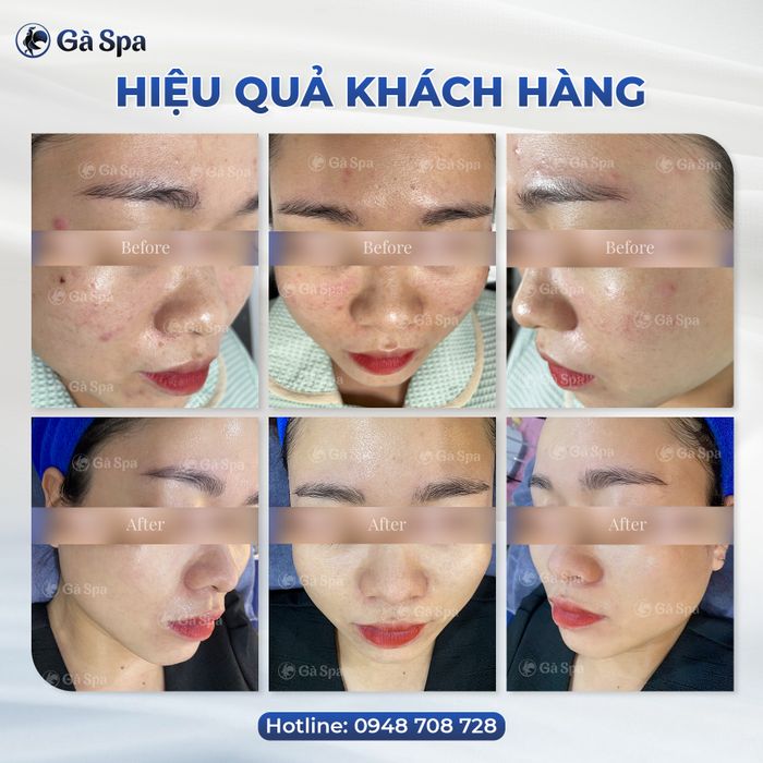 Quy trình trị mụn chuyên nghiệp tại Gà Spa