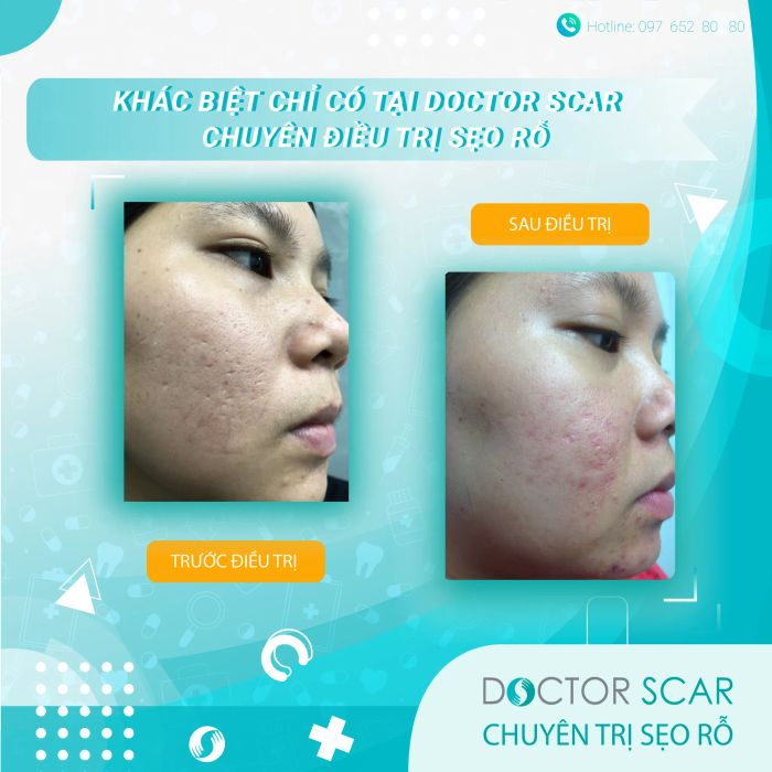 Hình ảnh quy trình điều trị sẹo chuyên nghiệp tại Doctor Scar