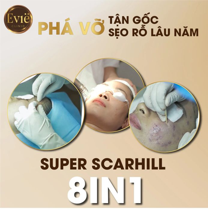 Kết quả điều trị sẹo rỗ ấn tượng tại Evie Clinic