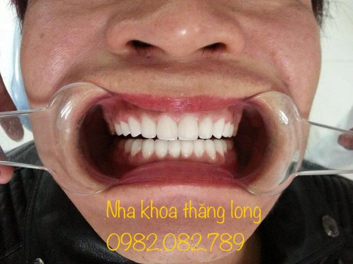 Hình ảnh thực tế Nha Khoa Thăng Long Hà Nam
