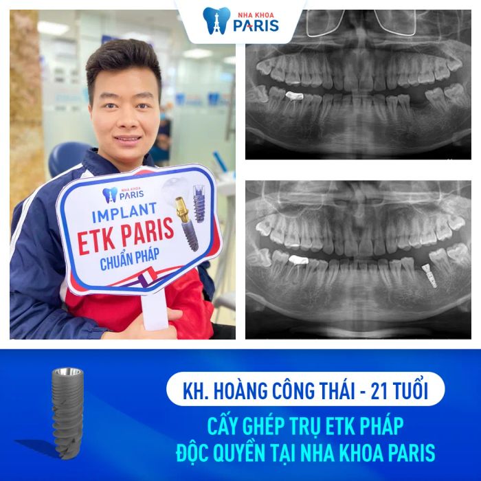 Nha Khoa Paris - Tinh hoa công nghệ trồng răng implant tại Thanh Hóa