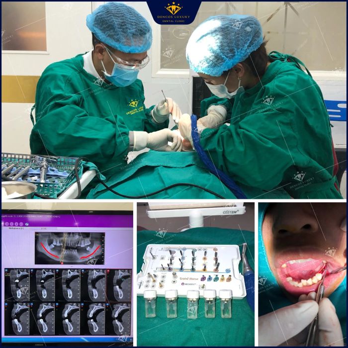 Nha Khoa Dencos Luxury - Địa chỉ đáng tin cậy cho dịch vụ trồng răng implant