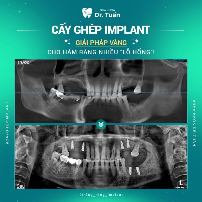 Nha Khoa Dr. Tuấn Nhà Thờ - Sự lựa chọn tối ưu cho dịch vụ trồng răng Implant tại Thanh Hóa