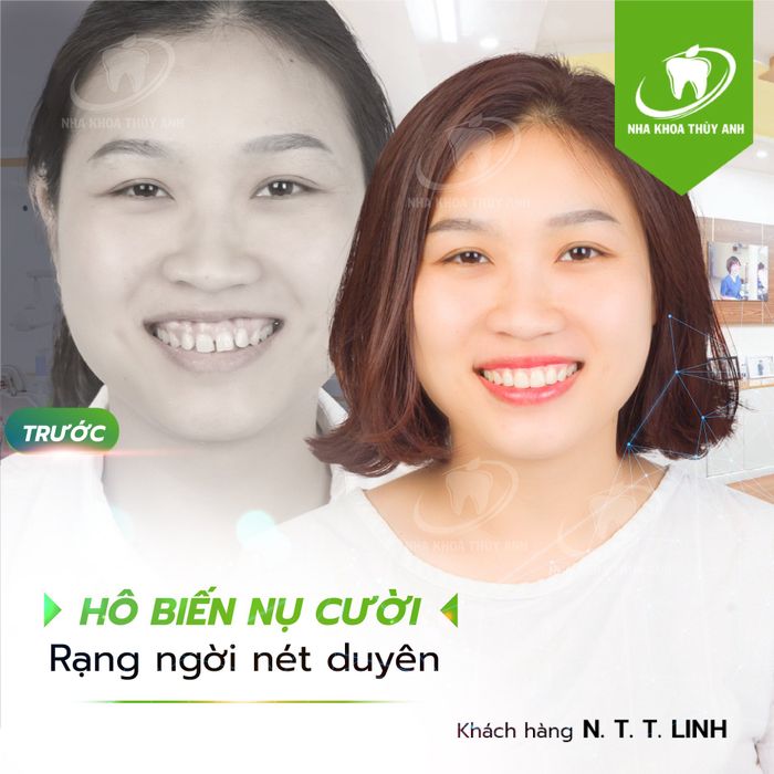Hình ảnh nụ cười hoàn hảo sau khi bọc răng sứ tại Nha Khoa Thùy Anh