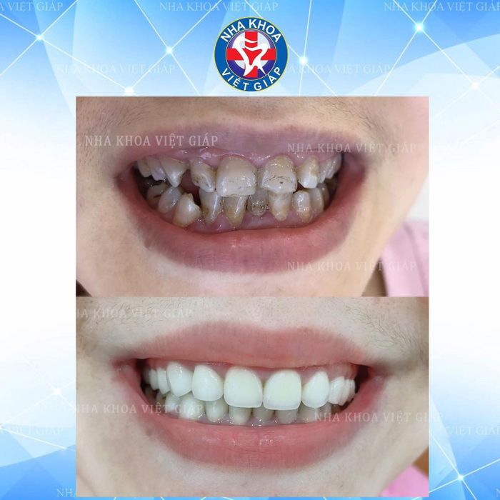 Hình ảnh khách hàng hài lòng sau khi bọc răng sứ tại Nha Khoa Việt Giáp