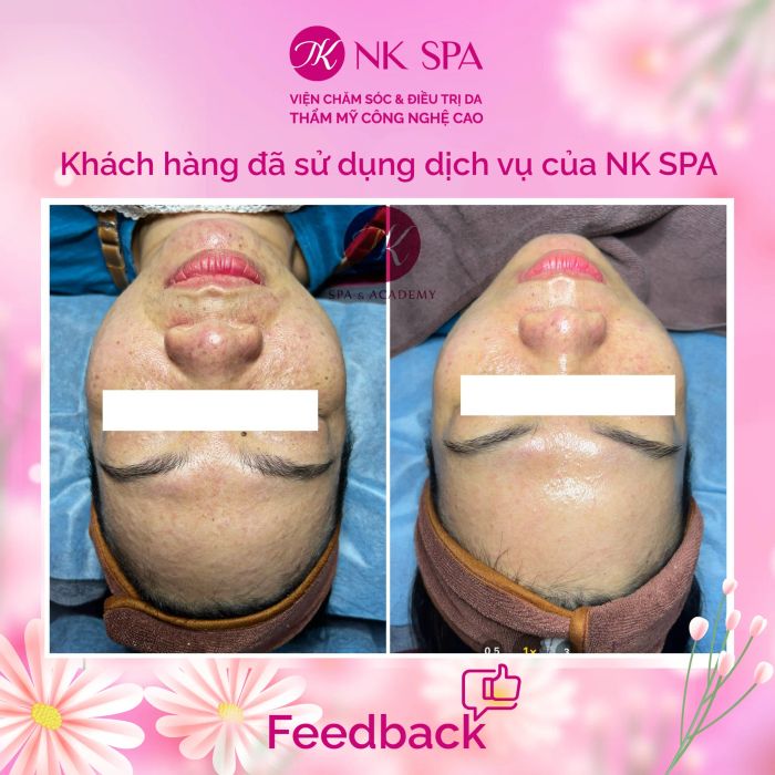 Quy trình trị mụn chuyên nghiệp tại NK Spa & Academy