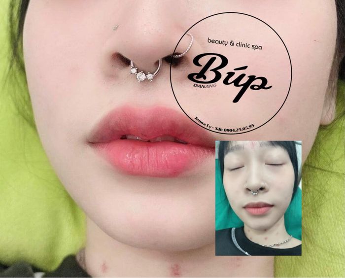 Hình ảnh thực tế về dịch vụ tại Búp Beauty & Clinic