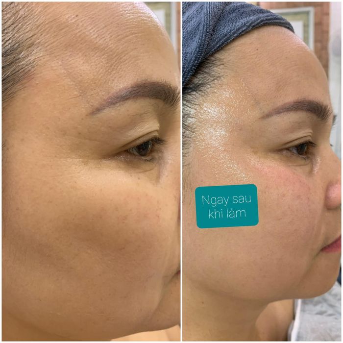 Kết quả ấn tượng: Khách hàng trước và sau điều trị nám tại E'Simi Beauty & Spa