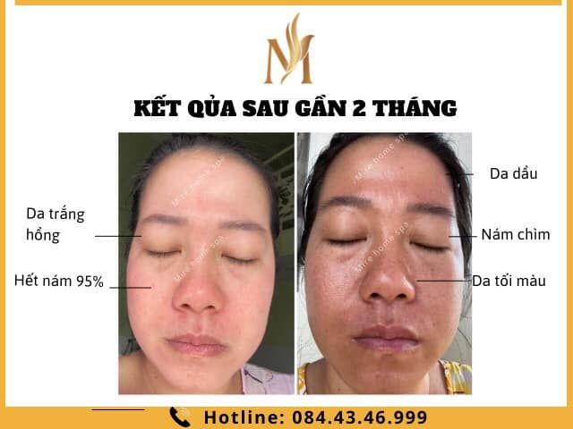 Mire Home Spa - Hình ảnh 2: Quy trình điều trị chuyên nghiệp