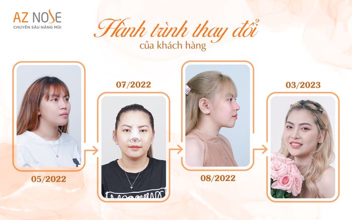 AZ NOSE - Hình ảnh thực tế về những ca nâng mũi đạt chuẩn tỉ lệ vàng