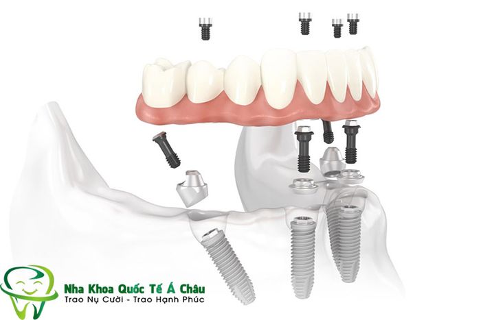 Hình ảnh quy trình cấy ghép implant chính xác bằng công nghệ hiện đại