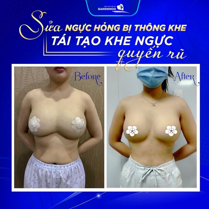 Hình ảnh phòng phẫu thuật đạt chuẩn tại Bệnh Viện Thẩm Mỹ Gangwhoo