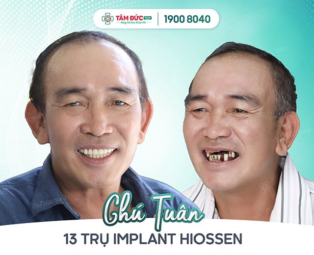 Hình ảnh quy trình cấy ghép Implant bằng công nghệ sóng siêu âm tại Nha Khoa Tâm Đức