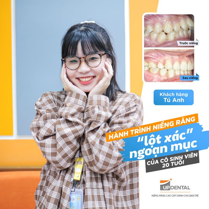 Nha khoa chuyên niềng răng Up Dental ảnh 2 - Hình ảnh minh họa về quy trình niềng răng tại Up Dental, nơi mà chất lượng và uy tín được đặt lên hàng đầu.